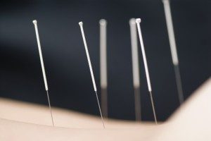 Acupunctura in medicina traditionala