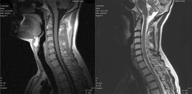 Hernie de disc la nivel cervical